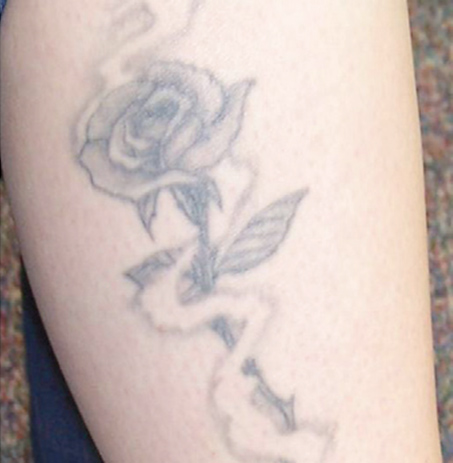 Tattoo removal – before